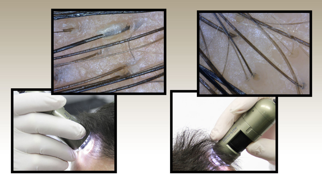 Analiza skóry głowy i włosów pod mikrokamerą oraz konsultacja trychologiczna